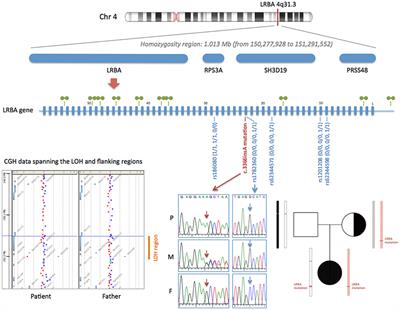 LRBA Deficiency in a Patient With a Novel Homozygous Mutation Due to Chromosome 4 Segmental Uniparental Isodisomy